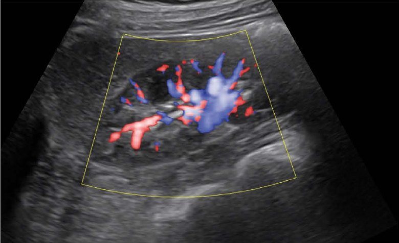 DPDI directional power Doppler ultrasound image of renal blood vessels