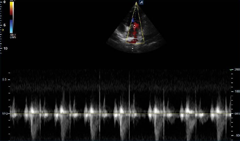 Echocardiogram with continuous wave Doppler