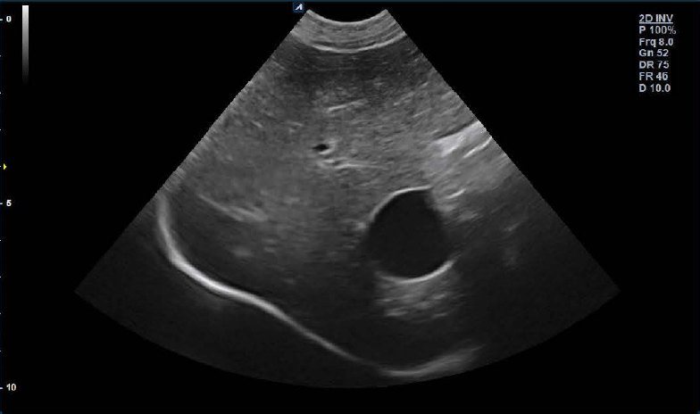 Gallbladder ultrasound image in 2D mode