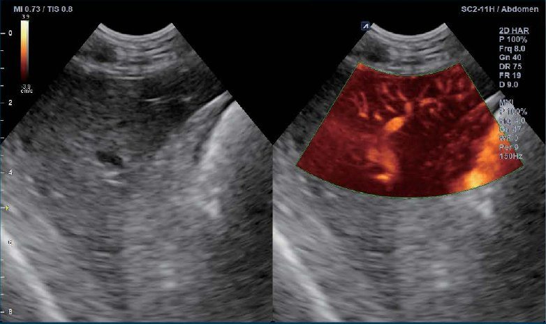 Liver ultrasound image in X+ MicroView mode