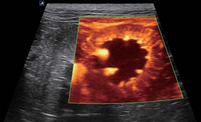 X+ MicroView vascular ultrasound image showing micro blood flow