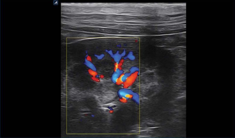 Renal ultrasound image in color flow mode